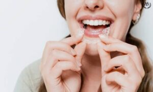 MK Aligners Kullaniminda Sosyal Hayatiniza Devam Etmek