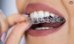 MK Aligners Tedavi Sureci Asamalar ve Sure