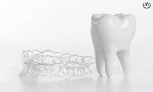 MK Aligners ile Dis Hareketlerini Hizlandirma Yontemleri