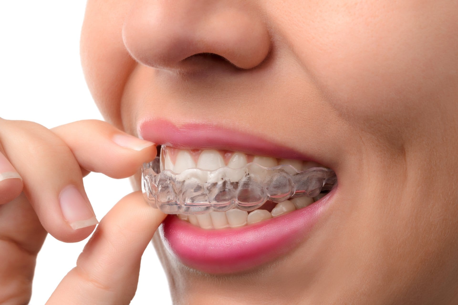 The Right Age for the First Orthodontic Checkup 1 MK Aligners Kullanirken Spor Yapmak Nelere Dikkat Edilmeli