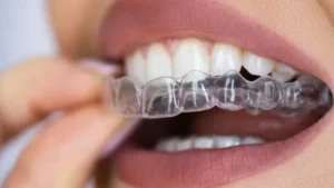 MK Aligners Tedavisi ve Dis Sagligi Iliskisi