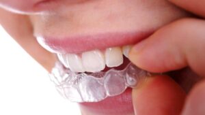 MK Aligners Tedavisinde Estetik Avantajlar