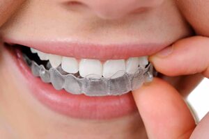 MK Aligners ile Dis Estetiginizi Nasil Gelistirebilirsiniz