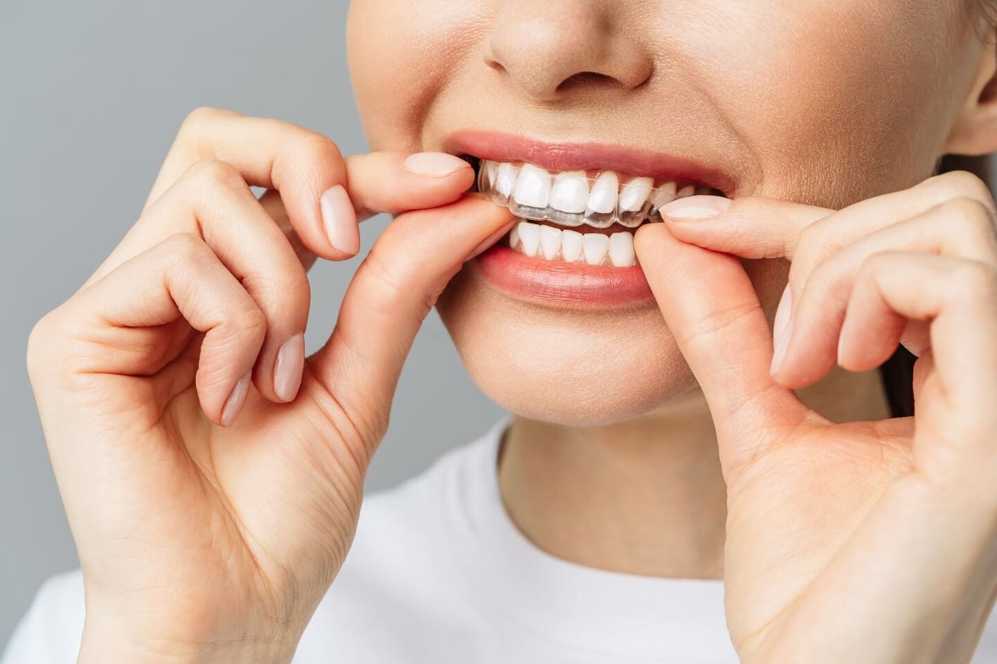 After Your Braces Come Off: Retainer Use During the Retention Phase 1 Seffaf Plak Tedavisinde Sosyal Hayatinizi Nasil Surdurursunuz